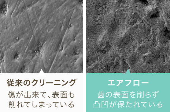 「従来のクリーニング：傷が出来て、表面も削れてしまっている」「エアフロー：歯の表面を削らず凸凹が保たれている」