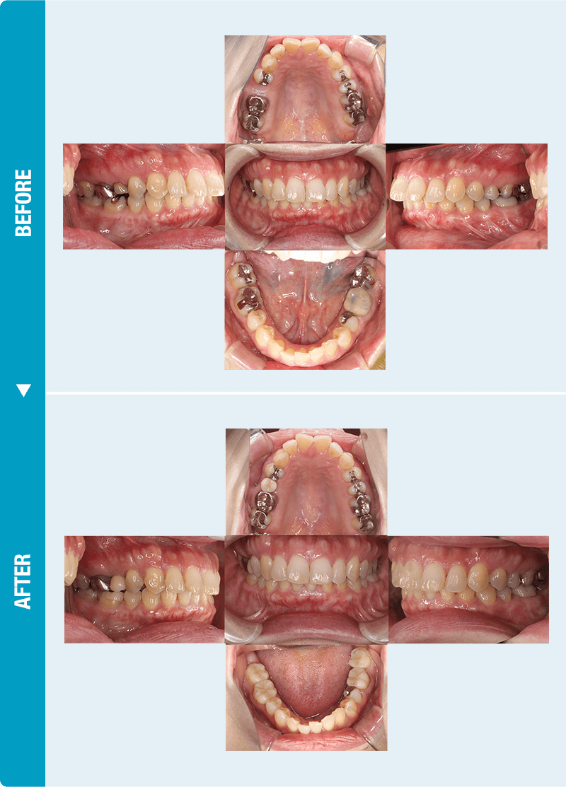 インプラント症例