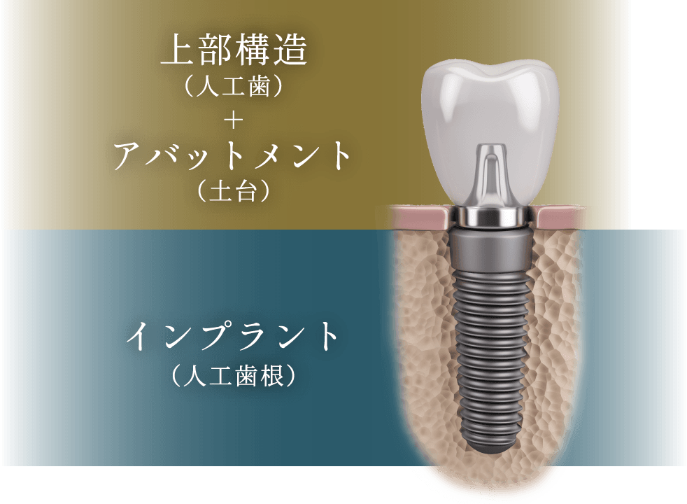 上部構造（人工歯）+ アバットメント（土台）+ インプラント（人工歯根）