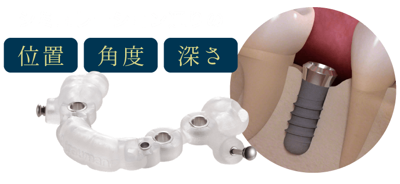 シミュレーション通りの「位置」「角度」「深さ」