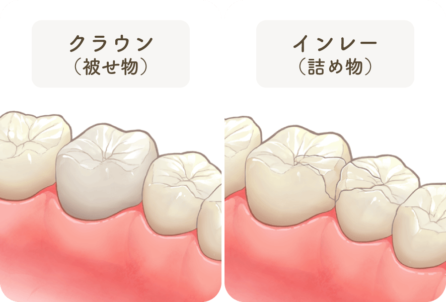 フルジルコニアクラウン（被せ物）／フルジルコニアインレー（詰め物）