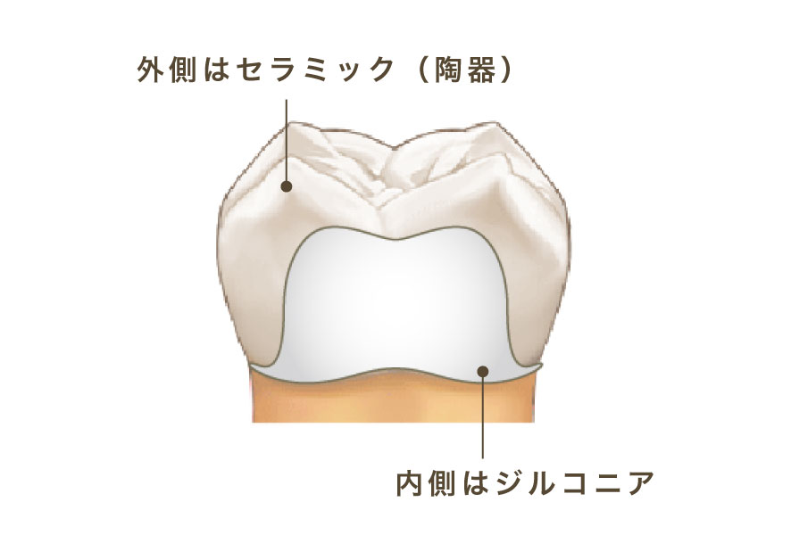 外側はセラミック（陶器）／内側はジルコニア