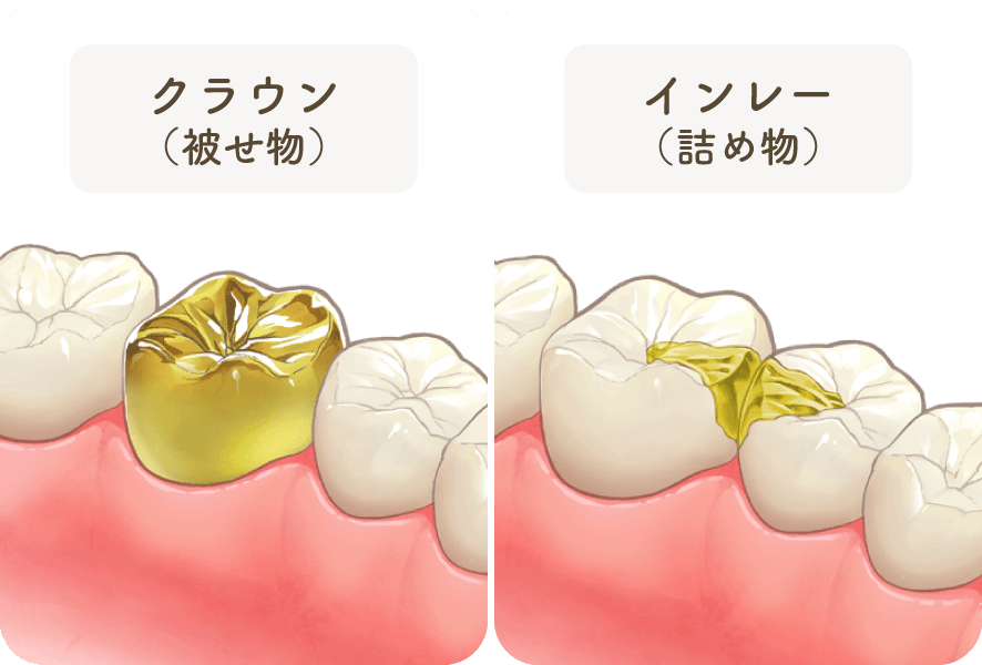 ゴールドクラウン（被せ物）／ゴールドインレー（詰め物）