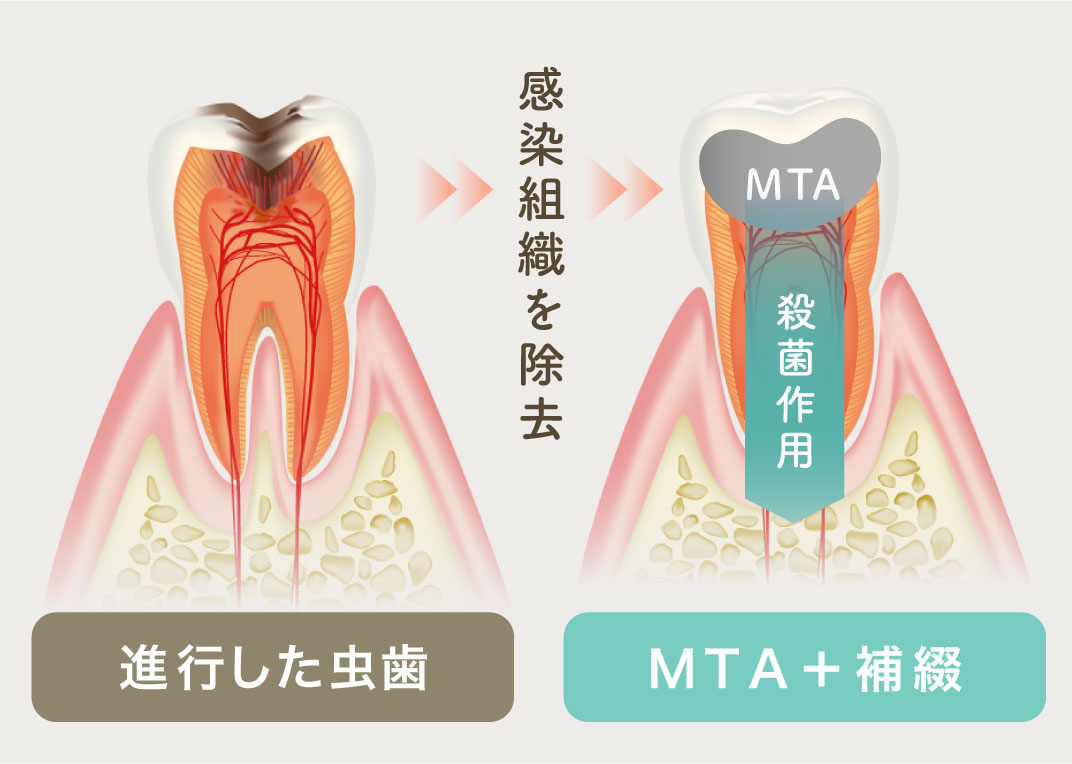 MTA+補綴