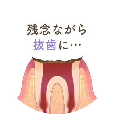 残念ながら抜歯に…