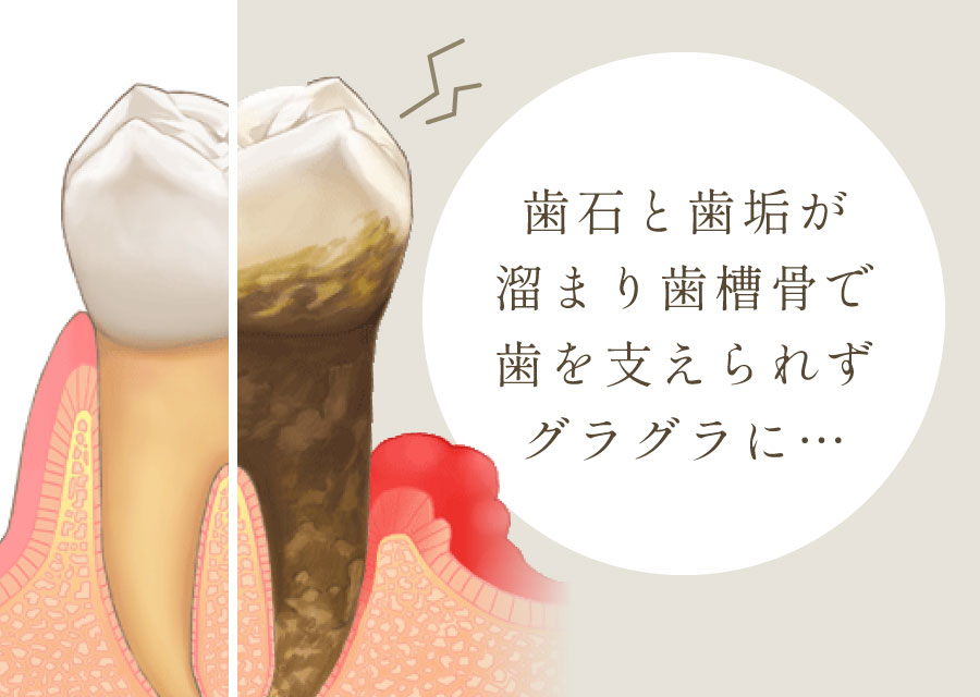 歯石と歯垢が溜まり歯槽骨で歯を支えられずグラグラに…