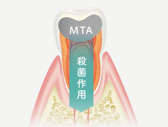MTAセメント