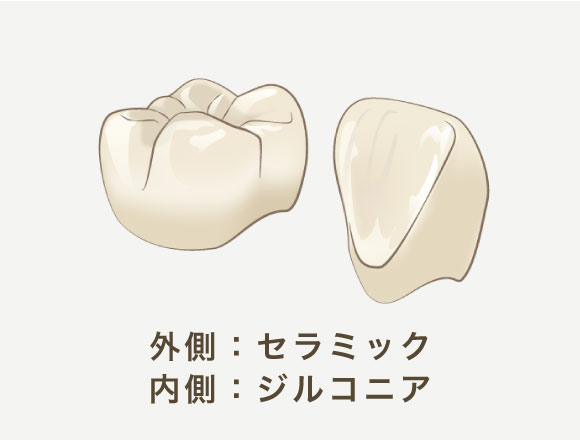 外側:セラミック/内側:ジルコニア