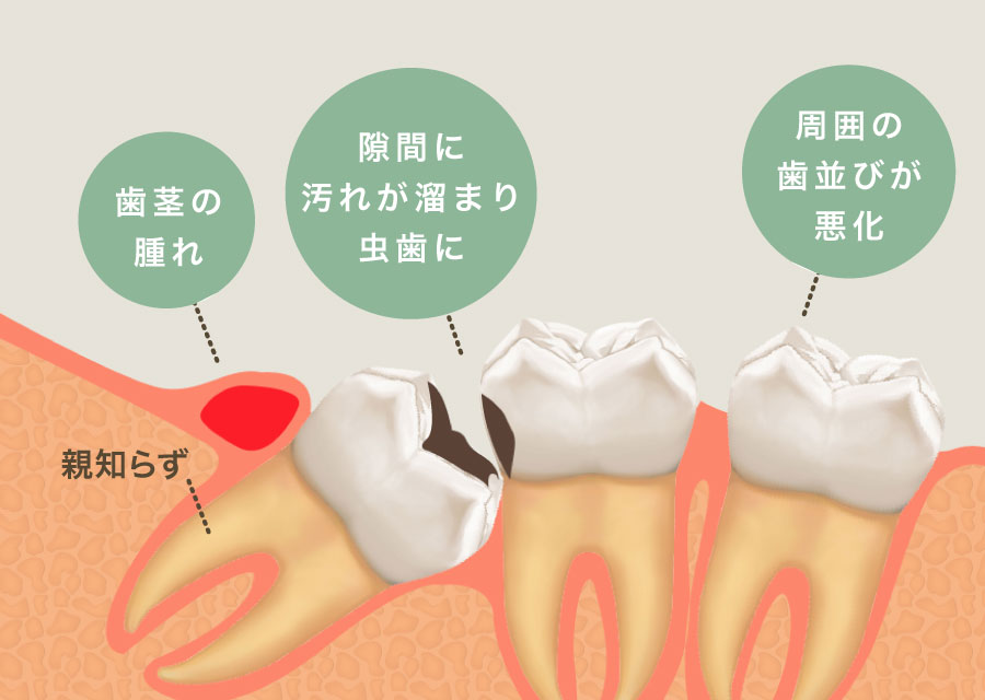 親知らずは「歯茎の腫れ」「隙間に汚れが溜まり虫歯に」「周囲の歯並びが悪化」などの原因となります